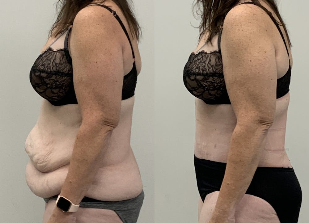 This is one of our beautiful post-bariatric body contouring patient #64