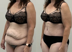 This is one of our beautiful patient 116 patient 116