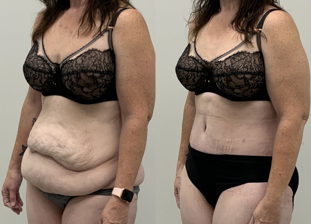This is one of our beautiful post-bariatric body contouring patient #64