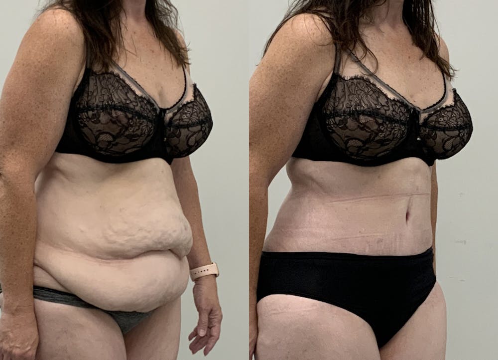 This is one of our beautiful post-bariatric body contouring patient #64