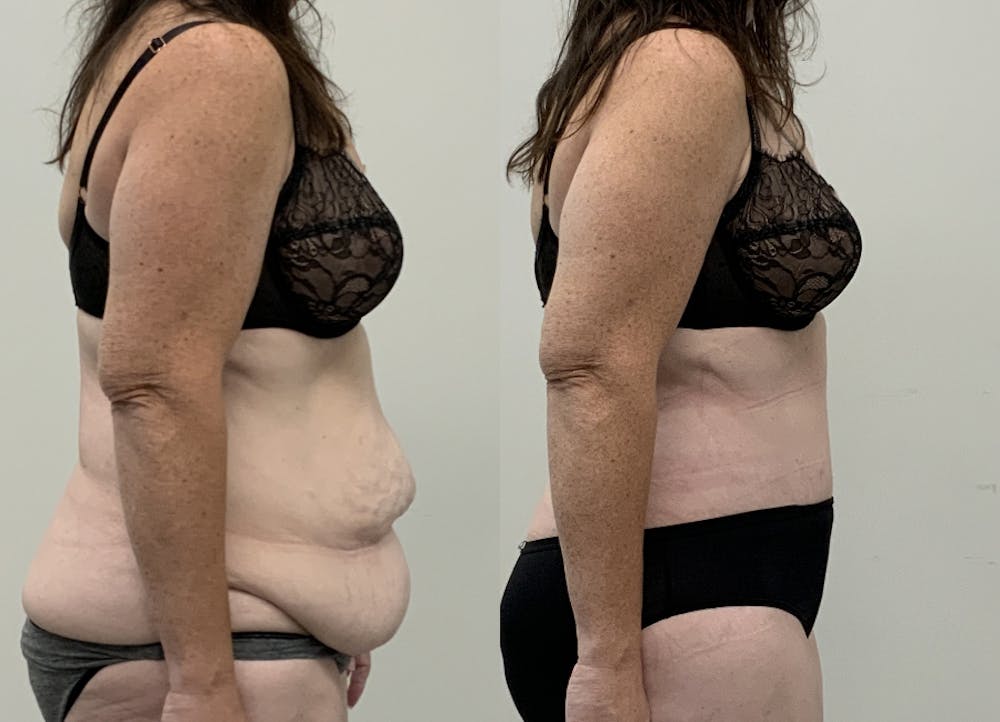 This is one of our beautiful post-bariatric body contouring patient #64