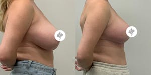 This is one of our beautiful breast reduction patient 27