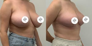 This is one of our beautiful breast reduction patient 27