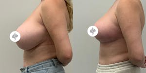 This is one of our beautiful breast reduction patient 27