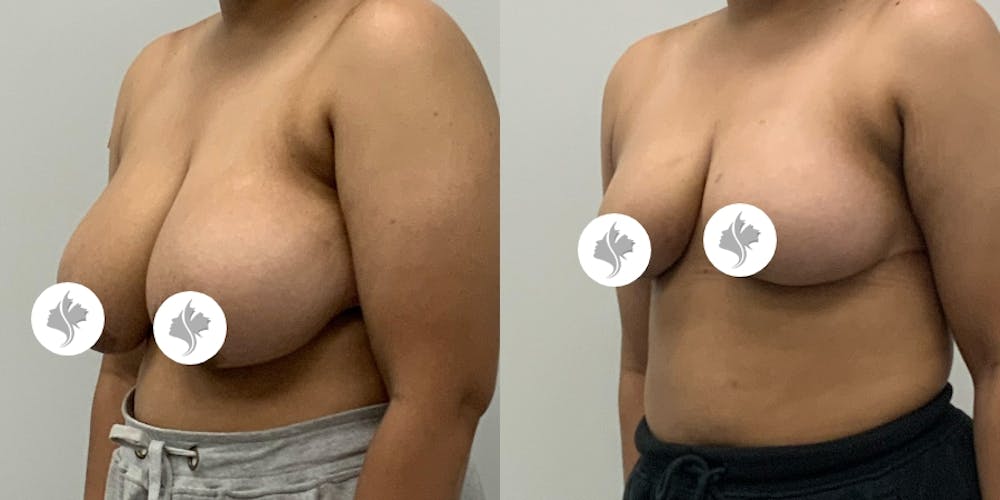 This is one of our beautiful breast asymmetry correction patient #14