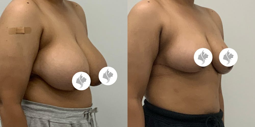 This is one of our beautiful breast asymmetry correction patient #14