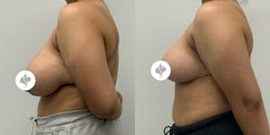 This is one of our beautiful breast reduction patient 89