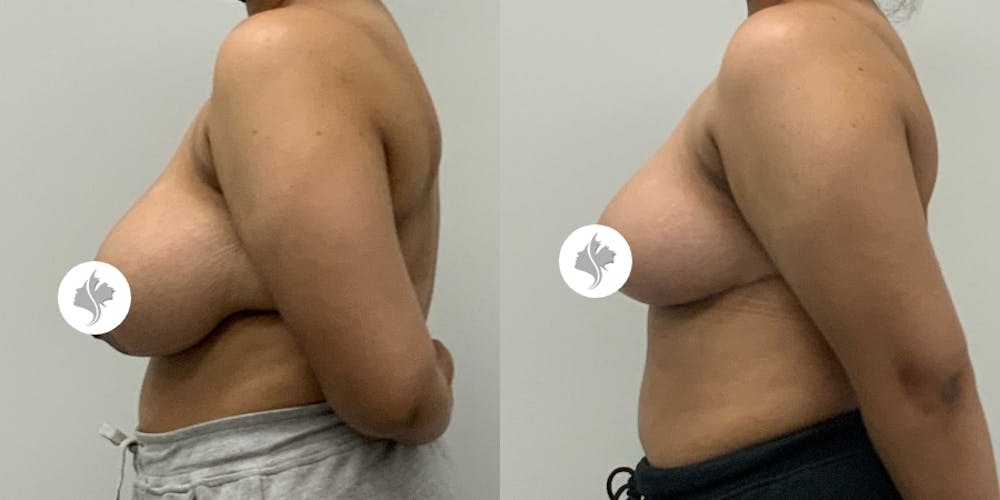 This is one of our beautiful breast asymmetry correction patient #14