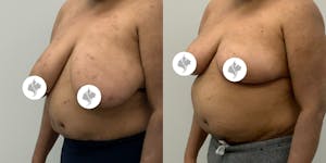 This is one of our beautiful breast reduction patient 90