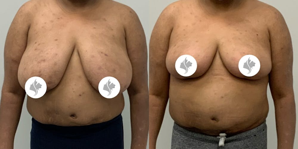 This is one of our beautiful breast reduction patient #90