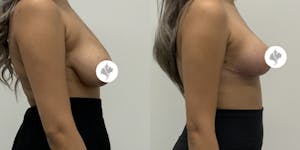 This is one of our beautiful breast reduction patient 28