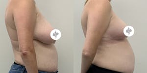 This is one of our beautiful breast reduction patient 91
