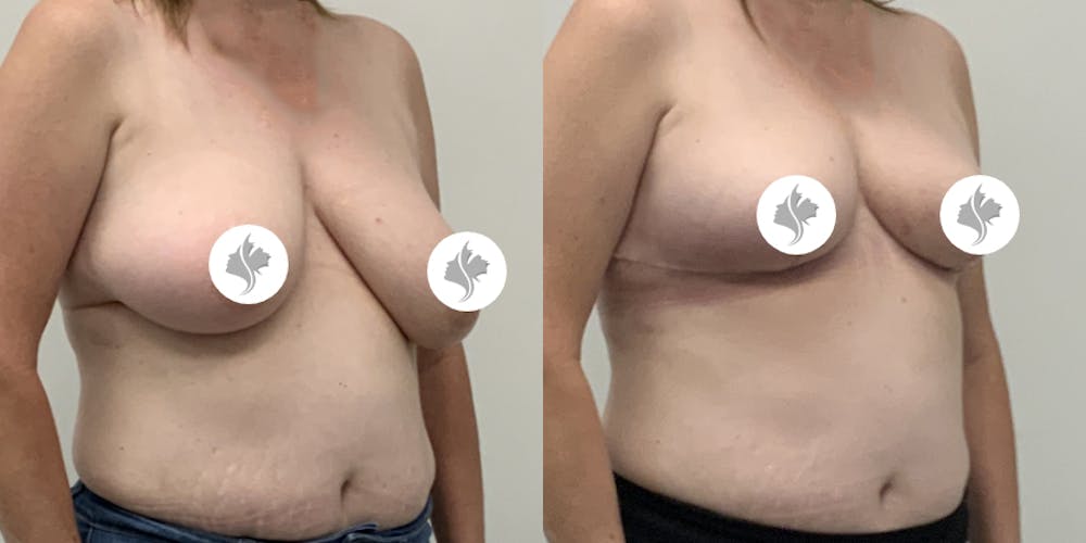 This is one of our beautiful breast asymmetry correction patient #21