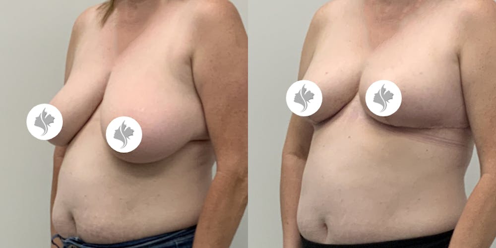 This is one of our beautiful breast asymmetry correction patient #21