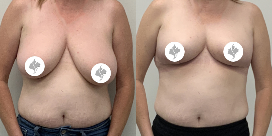 This is one of our beautiful breast asymmetry correction patient 21