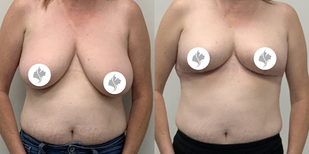 This is one of our beautiful breast asymmetry correction patient #21