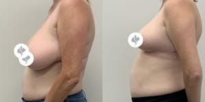 This is one of our beautiful breast asymmetry correction patient 21