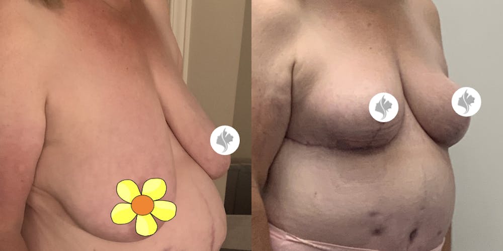 This is one of our beautiful breast reduction patient #93
