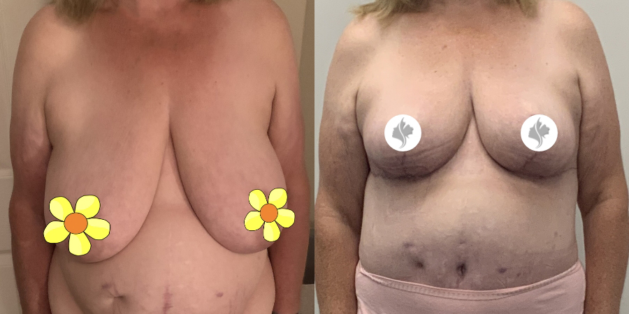 This is one of our beautiful breast reduction patient 92
