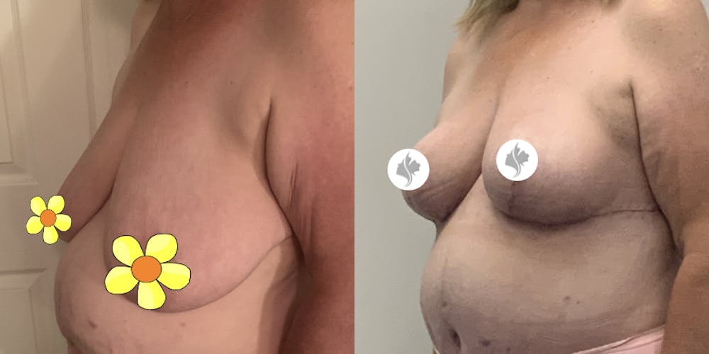 This is one of our beautiful breast reduction patient #92