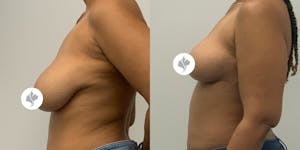 This is one of our beautiful breast reduction patient 24