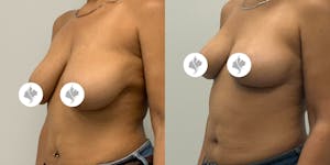 This is one of our beautiful breast reduction patient 24