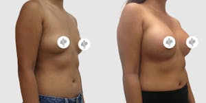 This is one of our beautiful breast augmentation patient 8