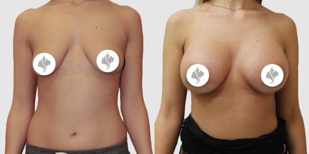 This is one of our beautiful breast augmentation patient #9