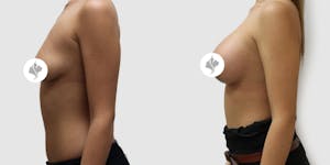 This is one of our beautiful breast augmentation patient 9