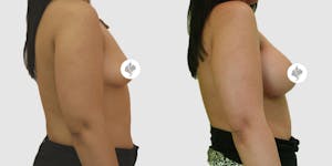 This is one of our beautiful breast augmentation patient 28