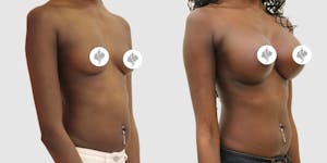 This is one of our beautiful breast augmentation patient 11