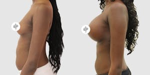 This is one of our beautiful breast augmentation patient 11