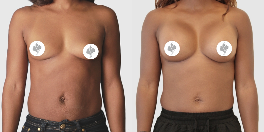 This is one of our beautiful breast augmentation patient 29