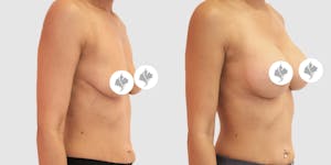 This is one of our beautiful breast augmentation patient 1