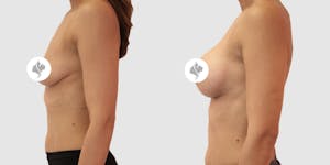 This is one of our beautiful breast augmentation patient 1
