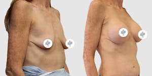 This is one of our beautiful breast augmentation patient 33