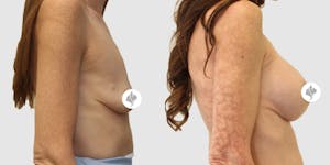 This is one of our beautiful breast augmentation patient 33