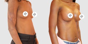 This is one of our beautiful breast augmentation patient 34