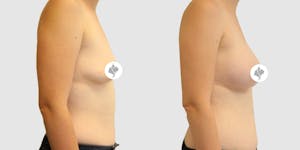 This is one of our beautiful breast augmentation patient 35