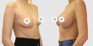 This is one of our beautiful breast augmentation patient 12