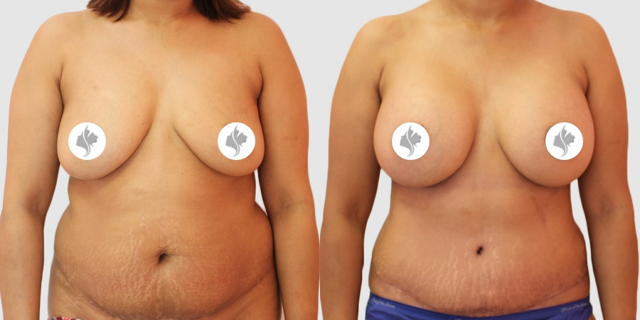 This is one of our beautiful breast augmentation patient 36