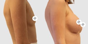 This is one of our beautiful breast augmentation patient 3