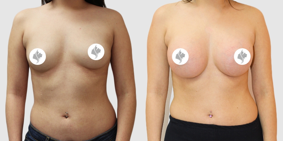This is one of our beautiful breast augmentation patient 37
