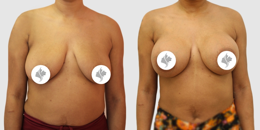 This is one of our beautiful breast augmentation patient 38