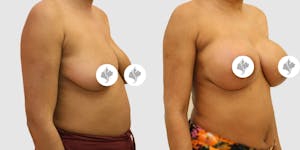 This is one of our beautiful breast augmentation patient 38