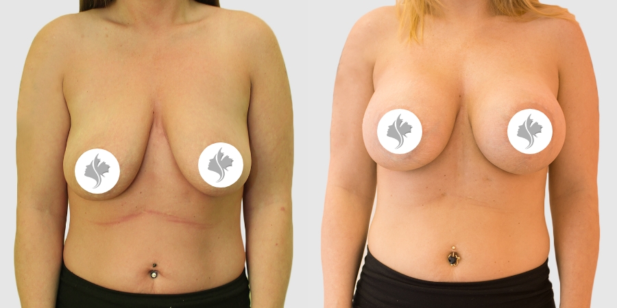 This is one of our beautiful breast augmentation with lift patient 2