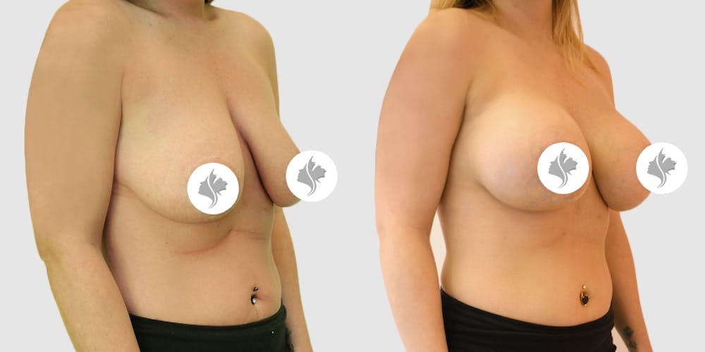 This is one of our beautiful breast augmentation with lift patient #2