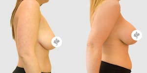 This is one of our beautiful breast augmentation with lift patient 2