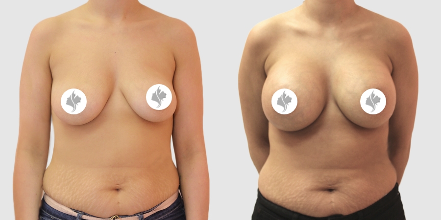 This is one of our beautiful breast augmentation patient 40