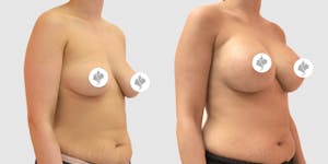 This is one of our beautiful breast augmentation patient 40